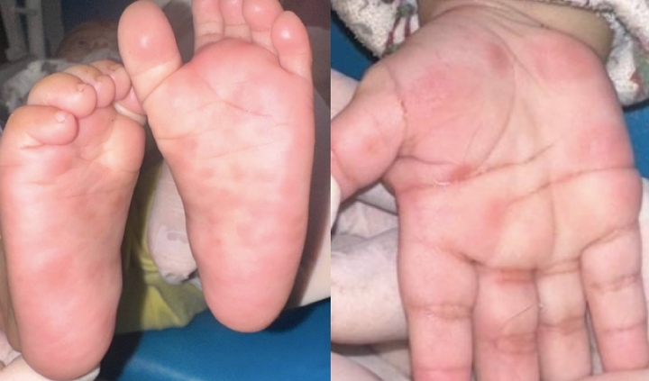 Trẻ 4 tháng tuổi mắc giang mai