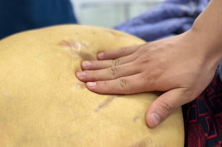 "Nát" gan, đối mặt ung thư vì thói quen nhiều người Việt vô tư làm